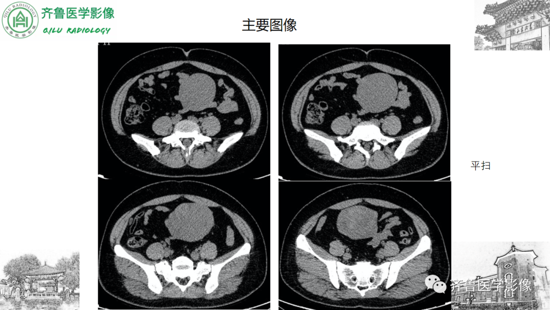 影像PPT - 【病例】卵巢透明细胞癌3例CT及MR影像-14