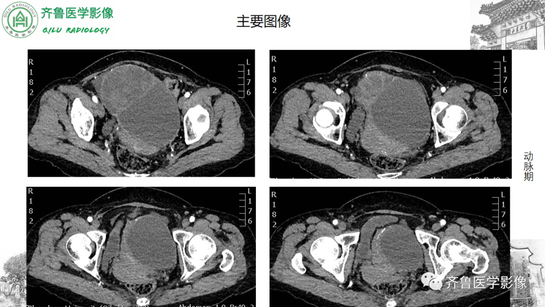 影像PPT - 【病例】卵巢透明细胞癌3例CT及MR影像-4