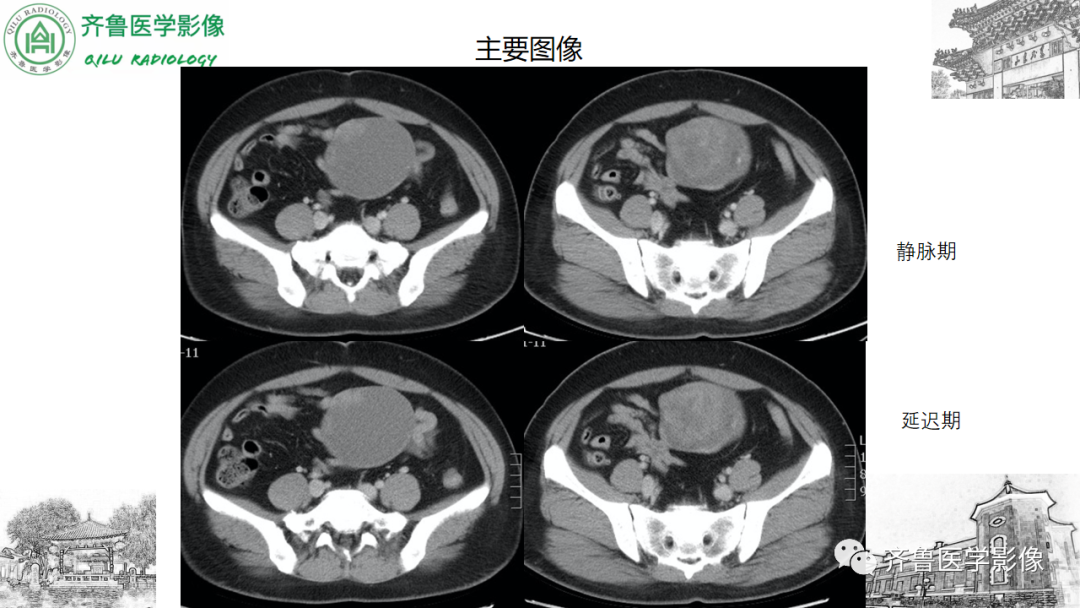 影像PPT - 【病例】卵巢透明细胞癌3例CT及MR影像-15