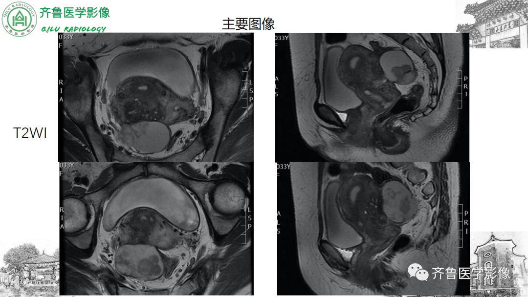 影像PPT - 【病例】卵巢透明细胞癌3例CT及MR影像-9