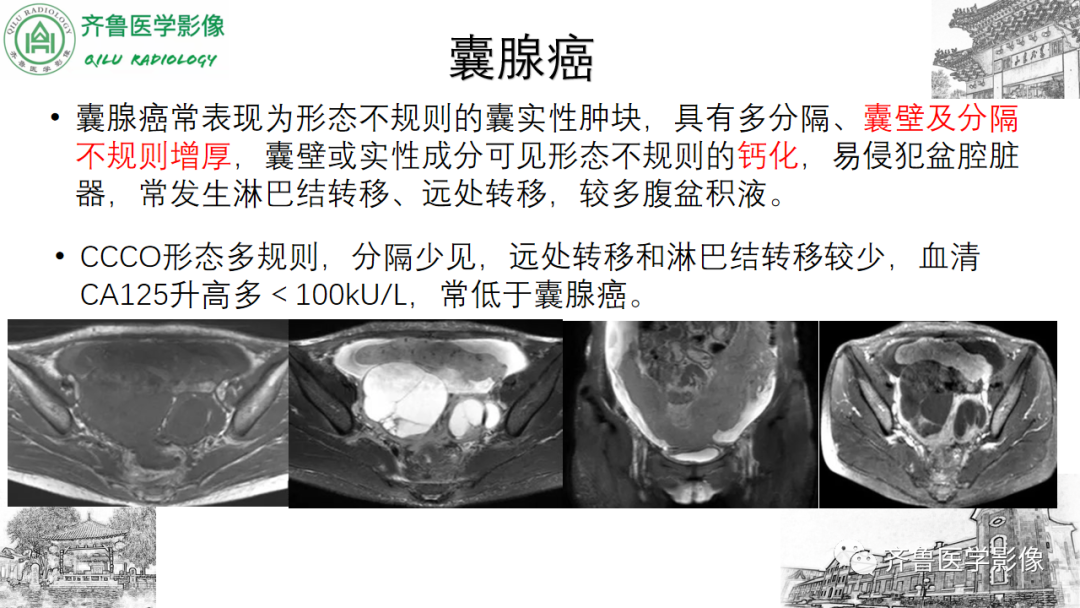 影像PPT - 【病例】卵巢透明细胞癌3例CT及MR影像-22