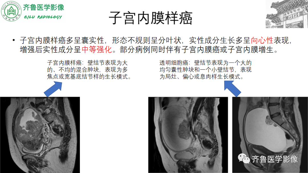 影像PPT - 【病例】卵巢透明细胞癌3例CT及MR影像-23