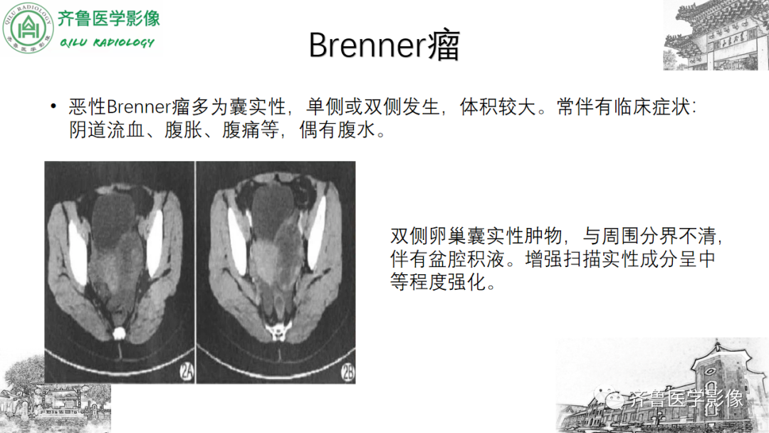 影像PPT - 【病例】卵巢透明细胞癌3例CT及MR影像-24