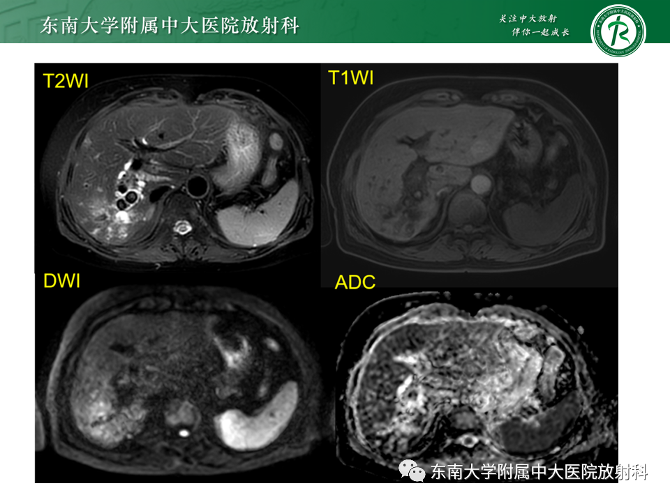 影像PPT - 【PPT】继发性肝内胆管局部扩张影像诊断思路-3