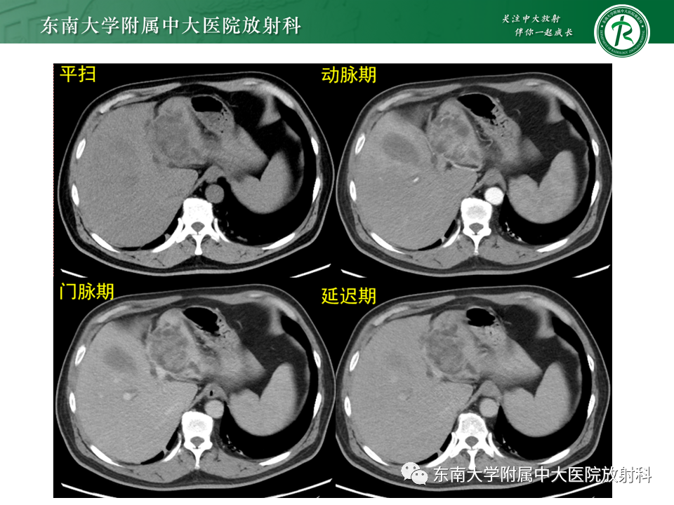 影像PPT - 【PPT】继发性肝内胆管局部扩张影像诊断思路-7