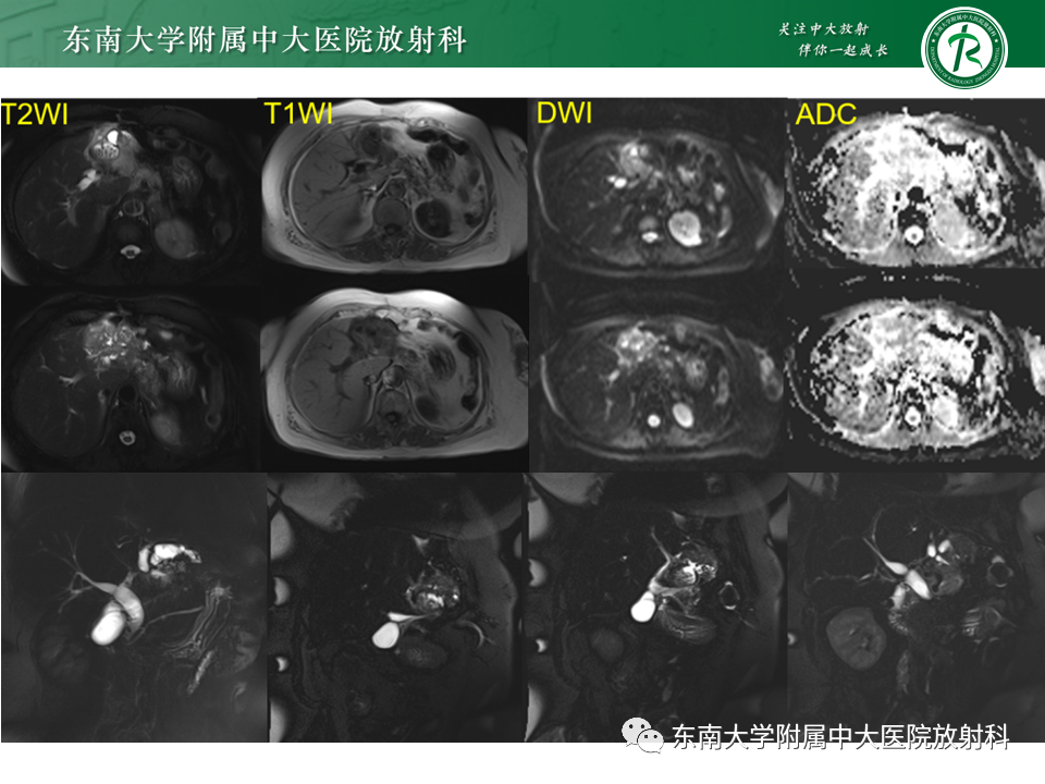 影像PPT - 【PPT】继发性肝内胆管局部扩张影像诊断思路-11