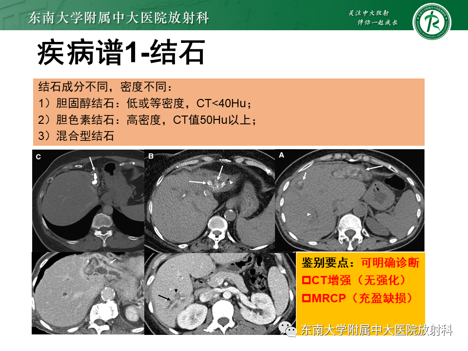 影像PPT - 【PPT】继发性肝内胆管局部扩张影像诊断思路-25