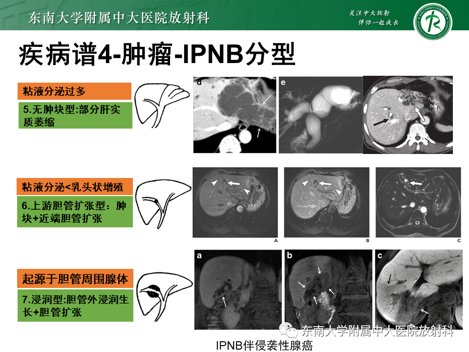 影像PPT - 【PPT】继发性肝内胆管局部扩张影像诊断思路-32