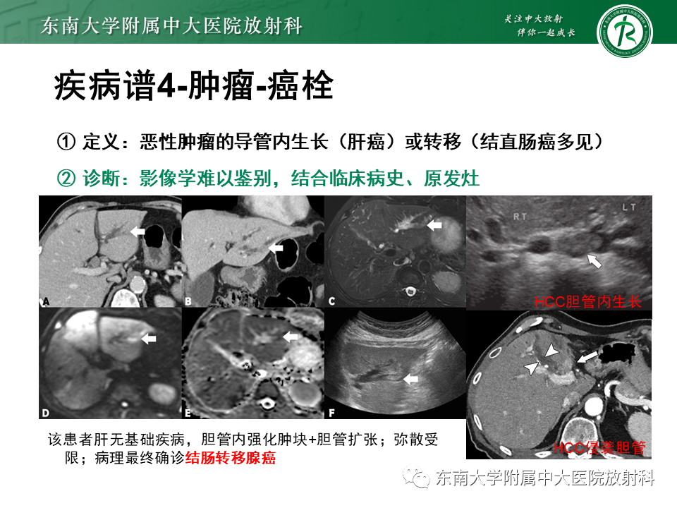 影像PPT - 【PPT】继发性肝内胆管局部扩张影像诊断思路-38
