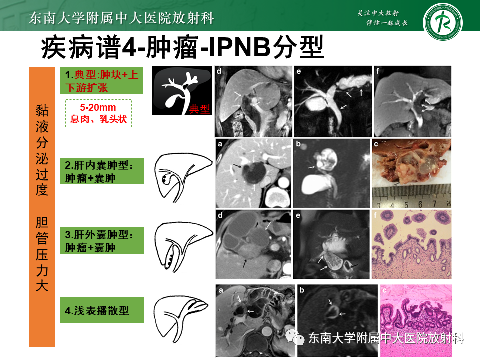 影像PPT - 【PPT】继发性肝内胆管局部扩张影像诊断思路-31