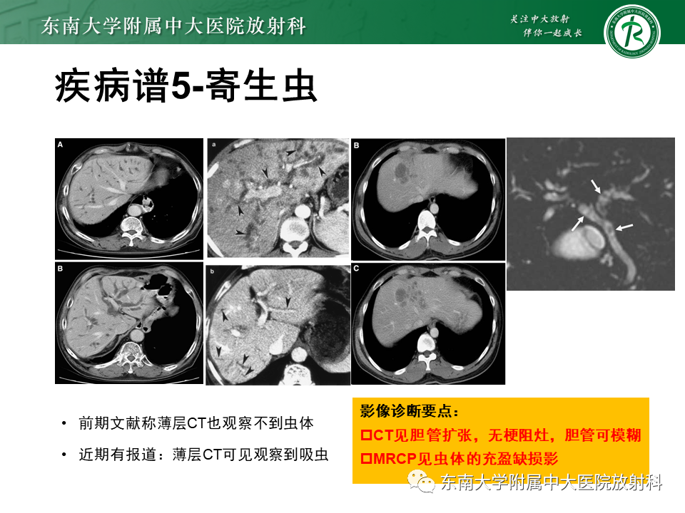 影像PPT - 【PPT】继发性肝内胆管局部扩张影像诊断思路-40