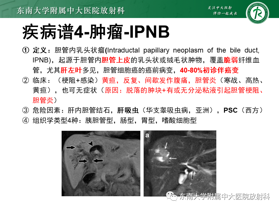 影像PPT - 【PPT】继发性肝内胆管局部扩张影像诊断思路-30