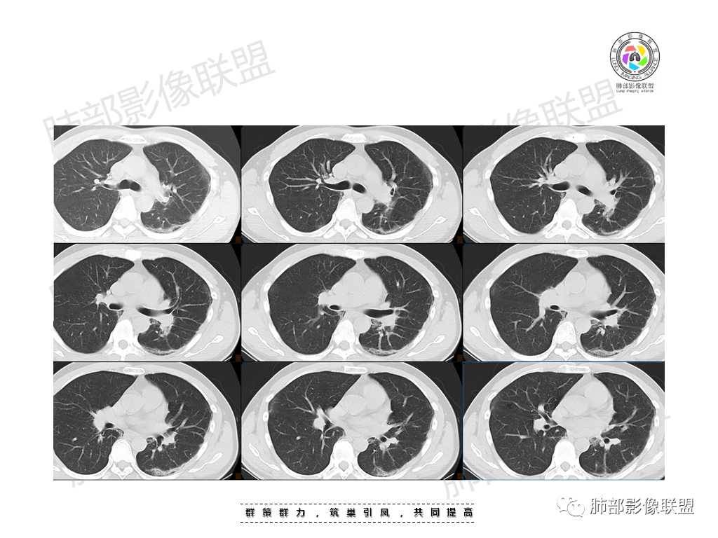影像PPT - 【病例】有机磷中毒肺部CT影像1例-6