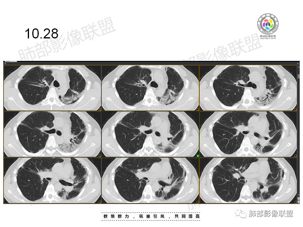 影像PPT - 【病例】有机磷中毒肺部CT影像1例-15