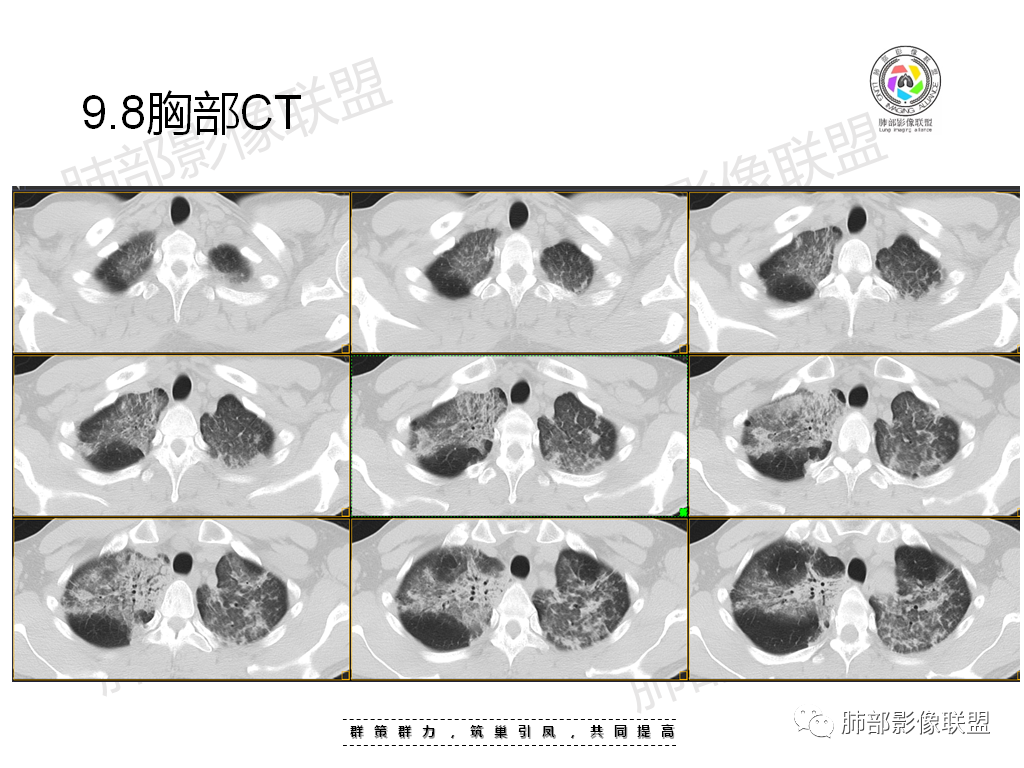 影像PPT - 【病例】有机磷中毒肺部CT影像1例-9