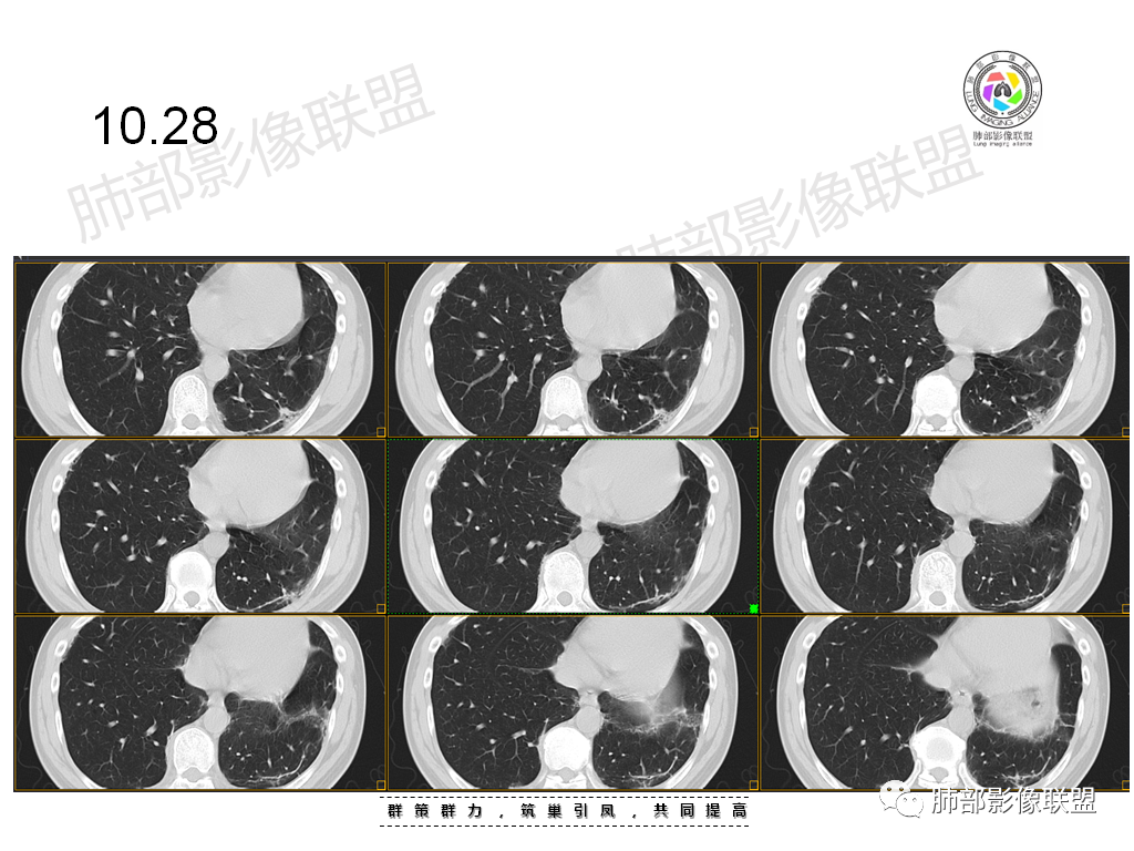 影像PPT - 【病例】有机磷中毒肺部CT影像1例-17