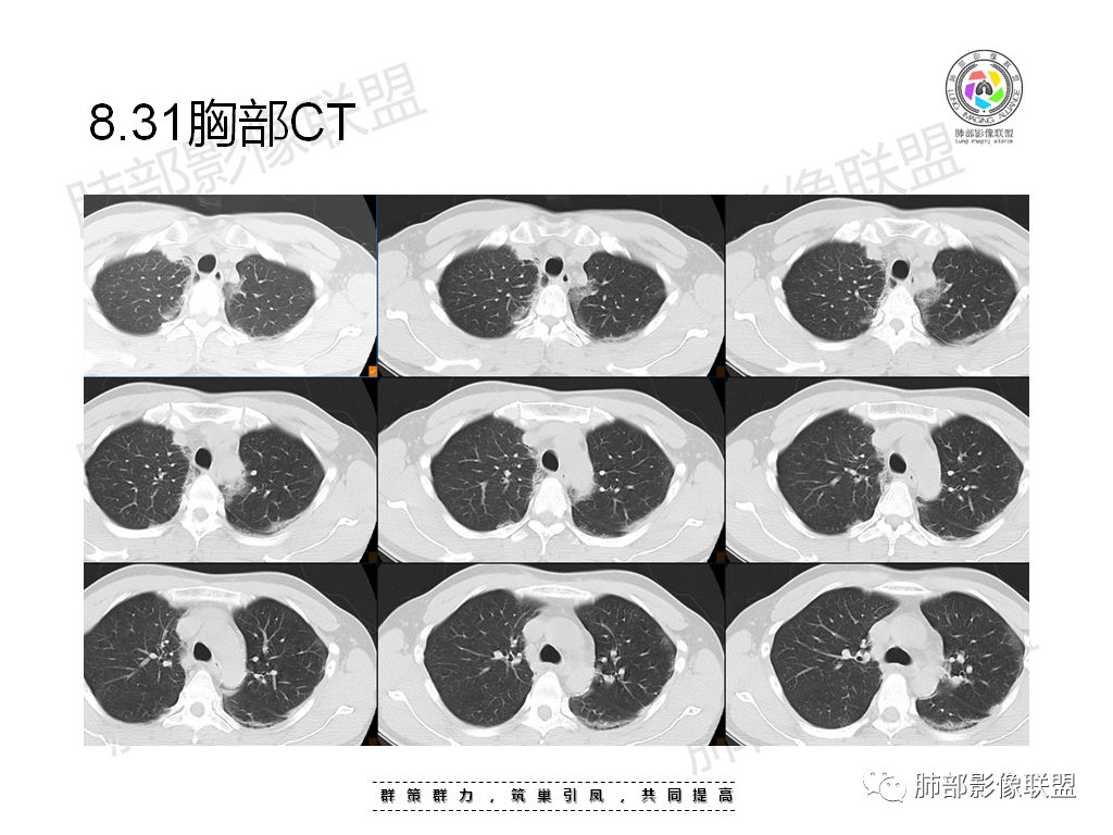影像PPT - 【病例】有机磷中毒肺部CT影像1例-5