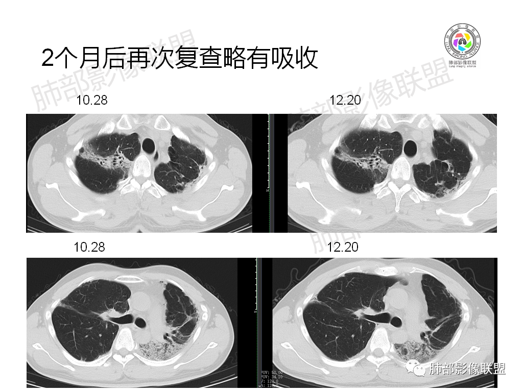 影像PPT - 【病例】有机磷中毒肺部CT影像1例-19
