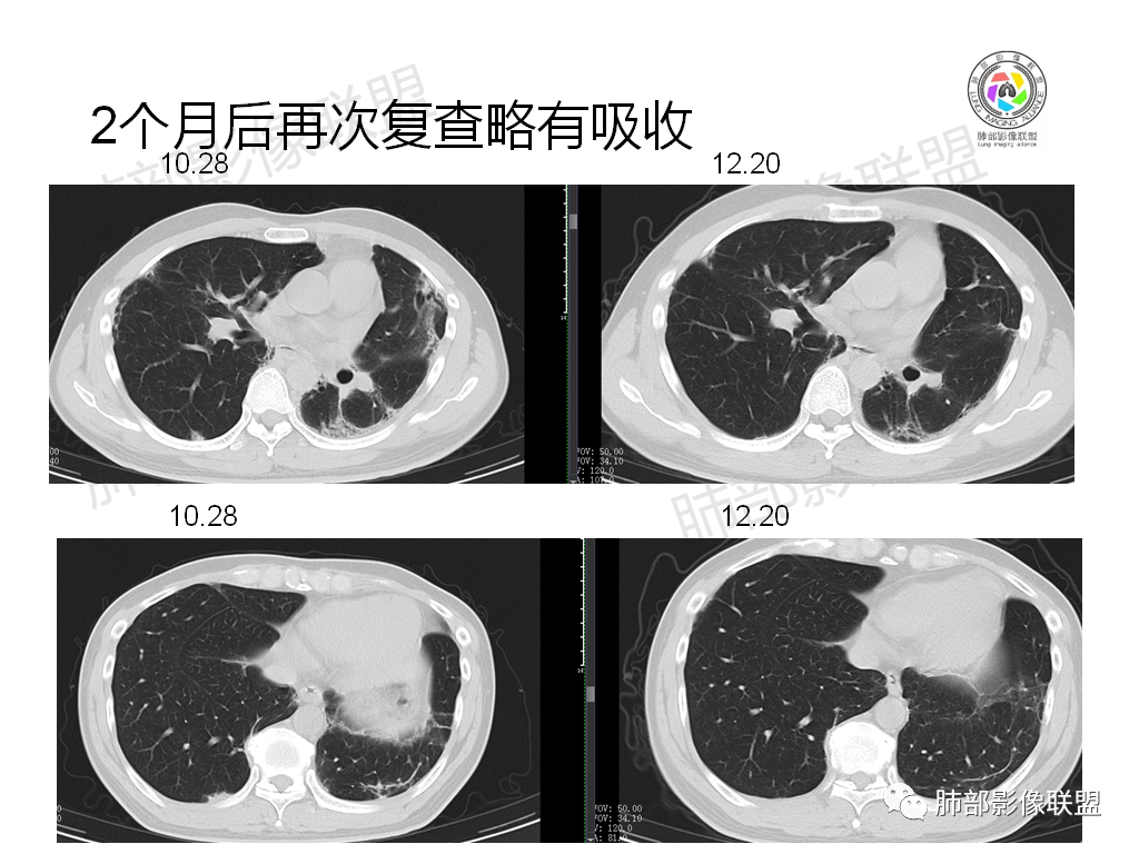 影像PPT - 【病例】有机磷中毒肺部CT影像1例-20