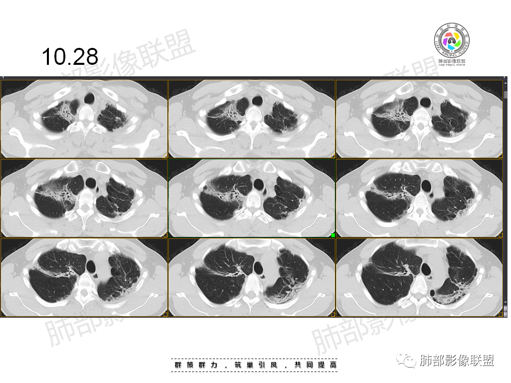 影像PPT - 【病例】有机磷中毒肺部CT影像1例-14