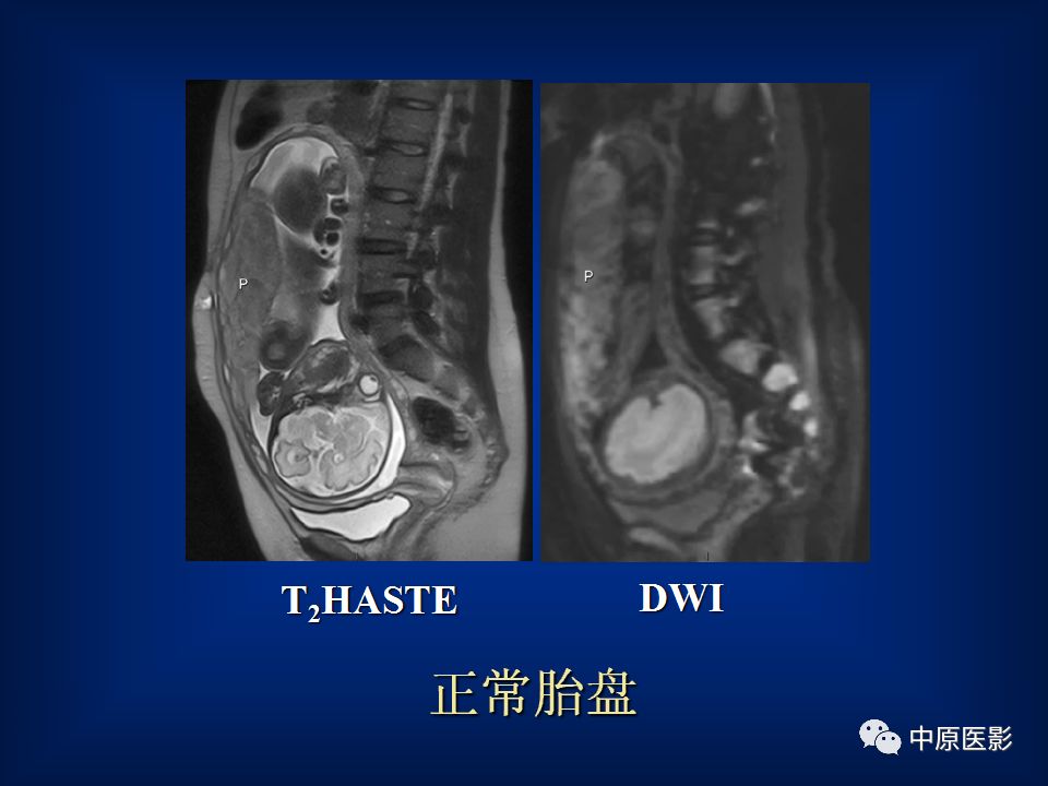 影像PPT - 【PPT】胎盘植入的MRI诊断-12