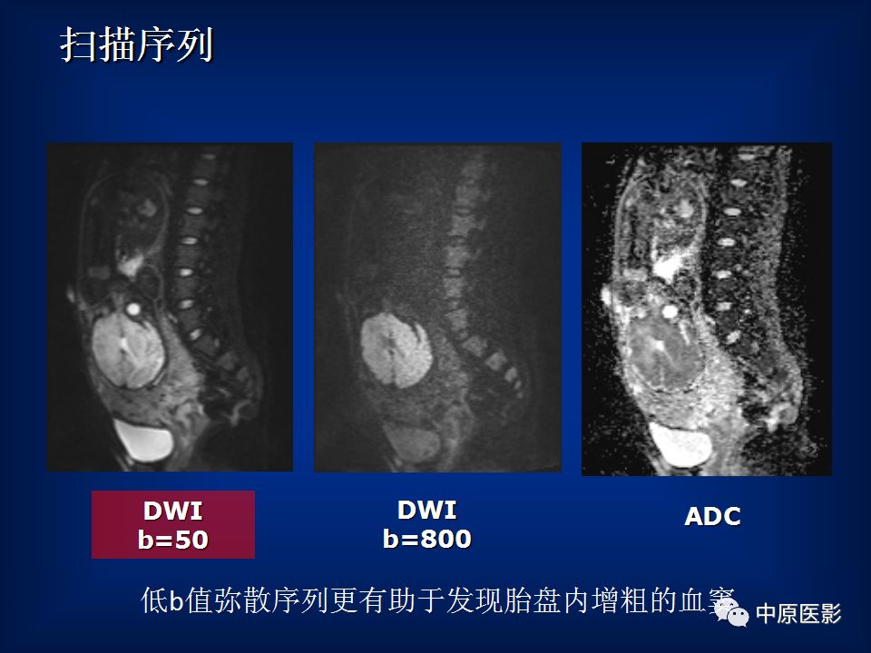 影像PPT - 【PPT】胎盘植入的MRI诊断-9