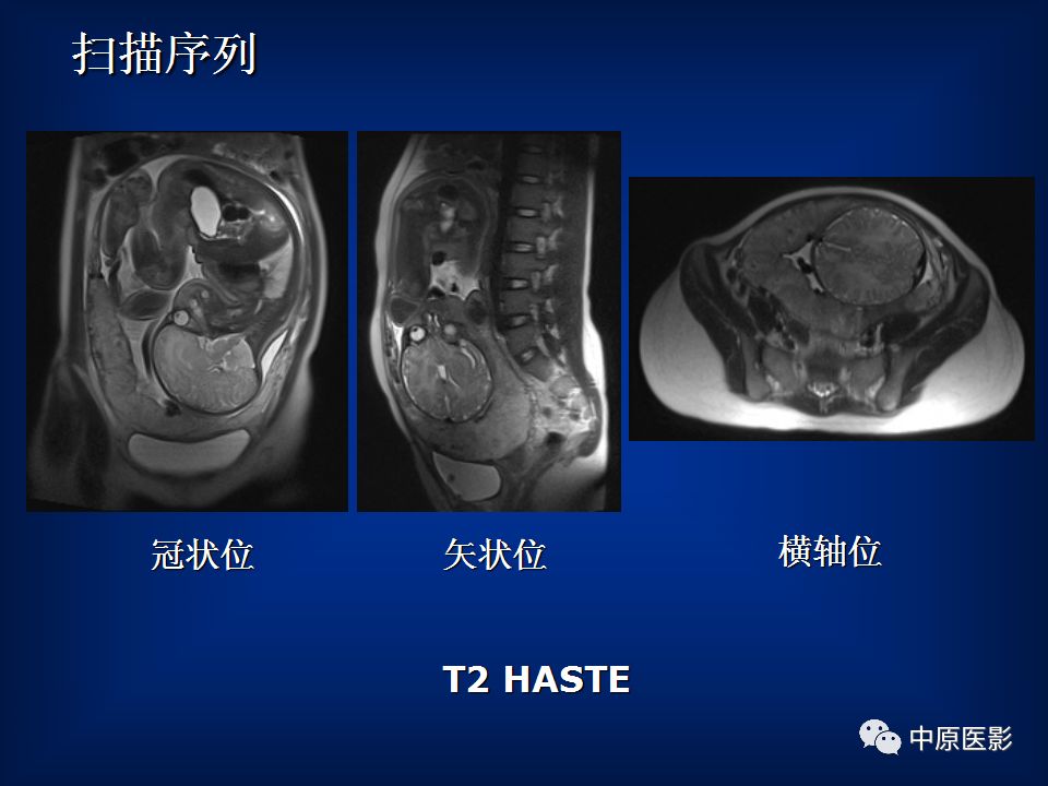 影像PPT - 【PPT】胎盘植入的MRI诊断-8