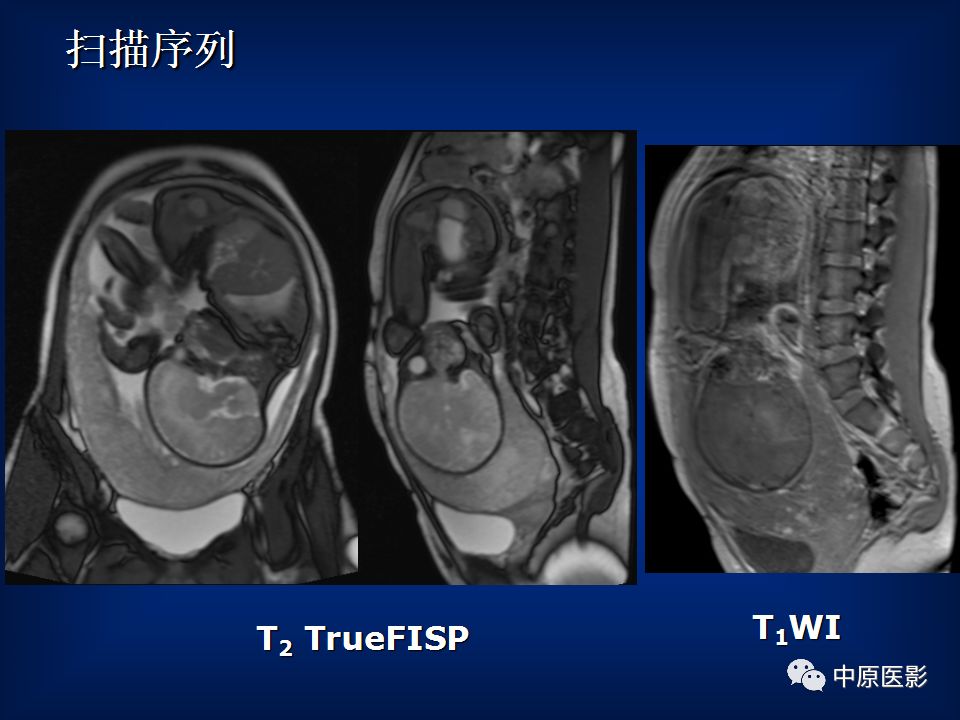 影像PPT - 【PPT】胎盘植入的MRI诊断-10