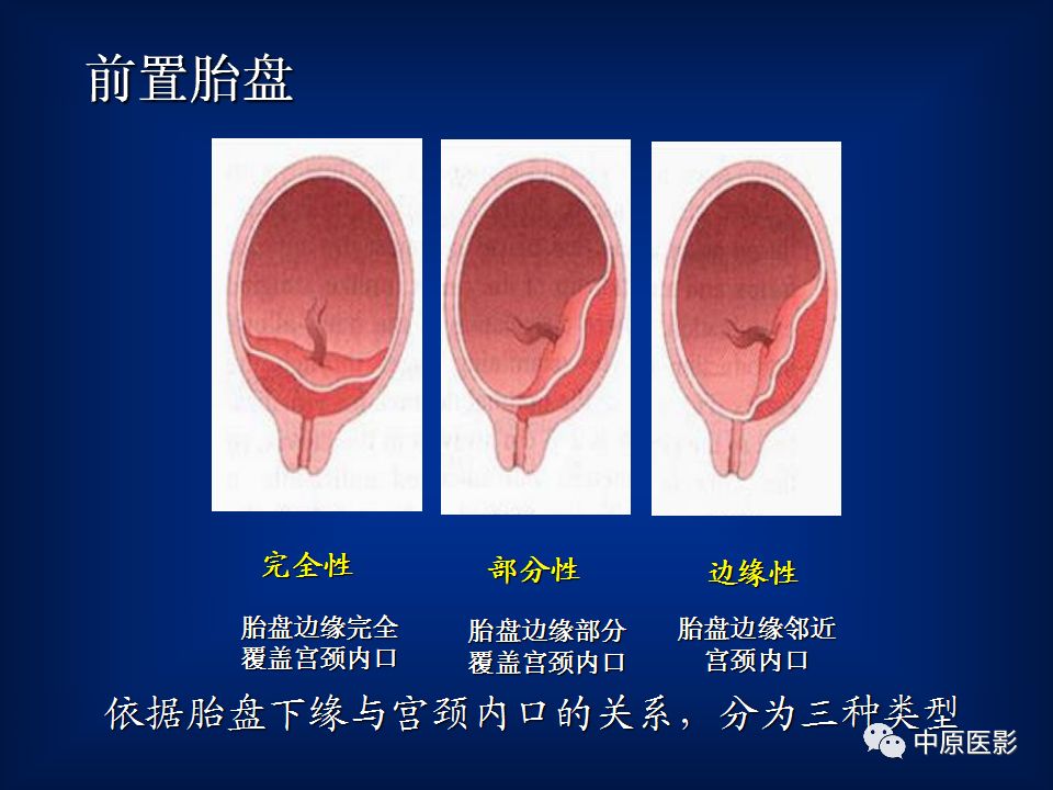 影像PPT - 【PPT】胎盘植入的MRI诊断-17
