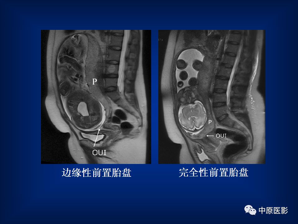 影像PPT - 【PPT】胎盘植入的MRI诊断-18