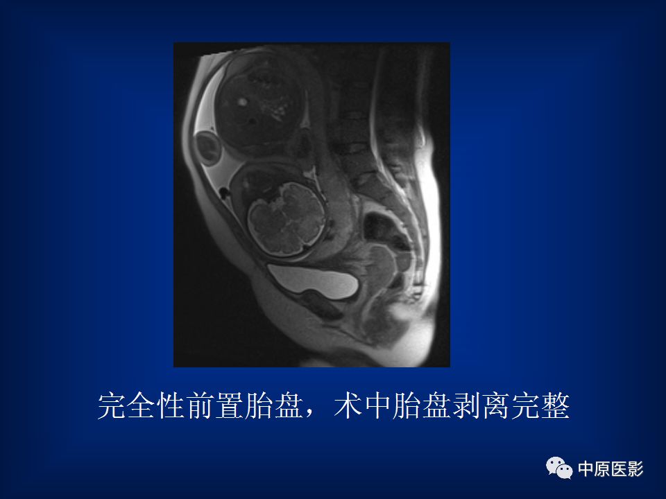 影像PPT - 【PPT】胎盘植入的MRI诊断-23