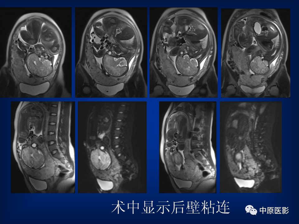 影像PPT - 【PPT】胎盘植入的MRI诊断-25
