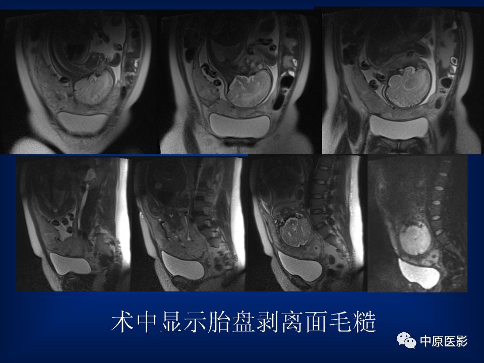 影像PPT - 【PPT】胎盘植入的MRI诊断-24