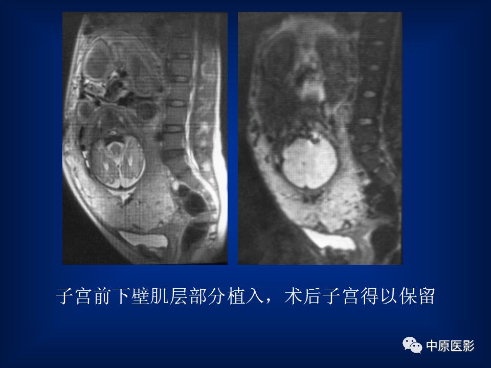 影像PPT - 【PPT】胎盘植入的MRI诊断-26