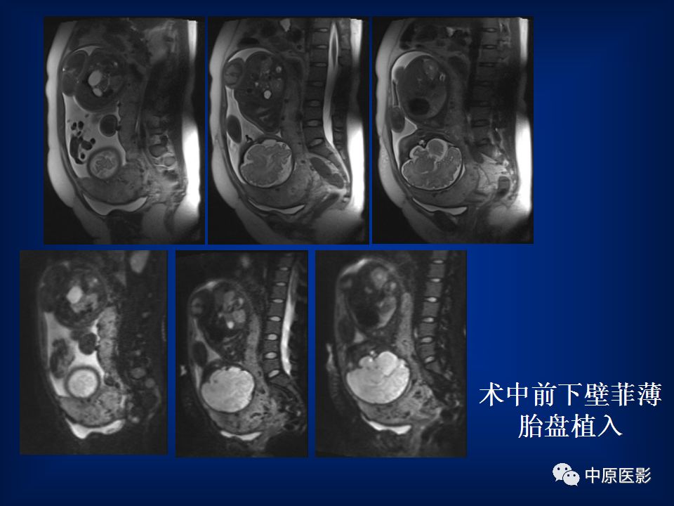 影像PPT - 【PPT】胎盘植入的MRI诊断-27