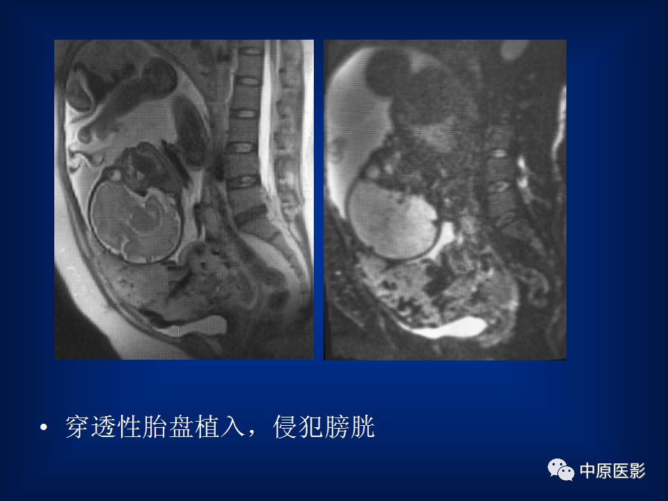 影像PPT - 【PPT】胎盘植入的MRI诊断-29