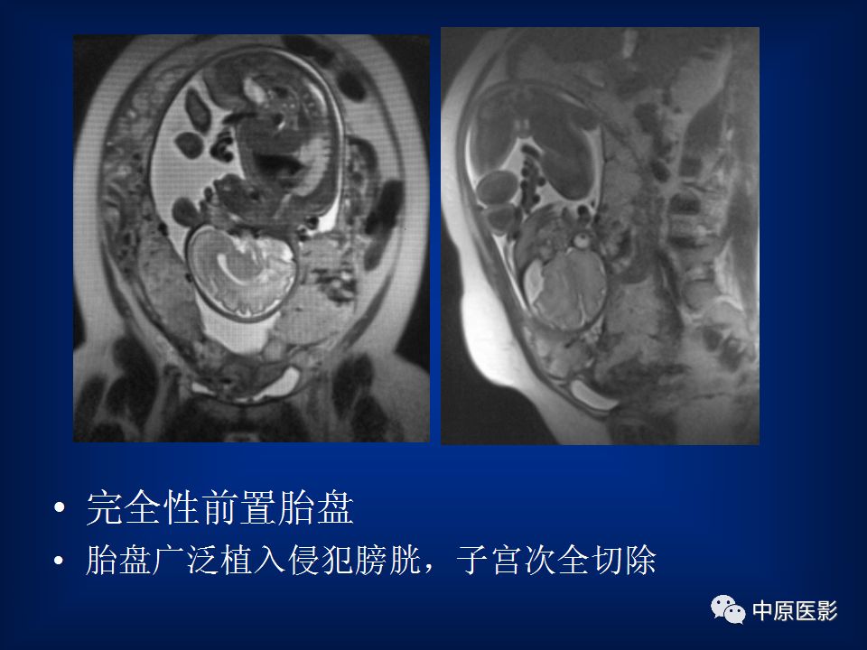影像PPT - 【PPT】胎盘植入的MRI诊断-30