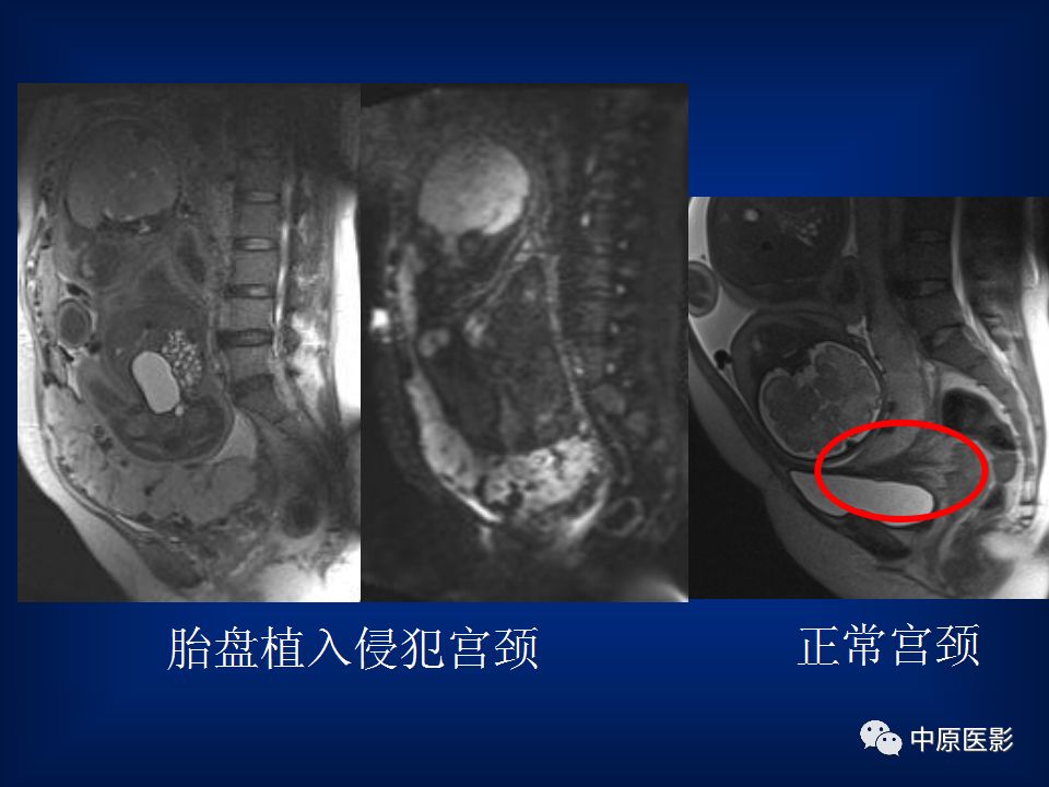 影像PPT - 【PPT】胎盘植入的MRI诊断-31