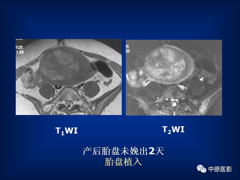 影像PPT - 【PPT】胎盘植入的MRI诊断-33