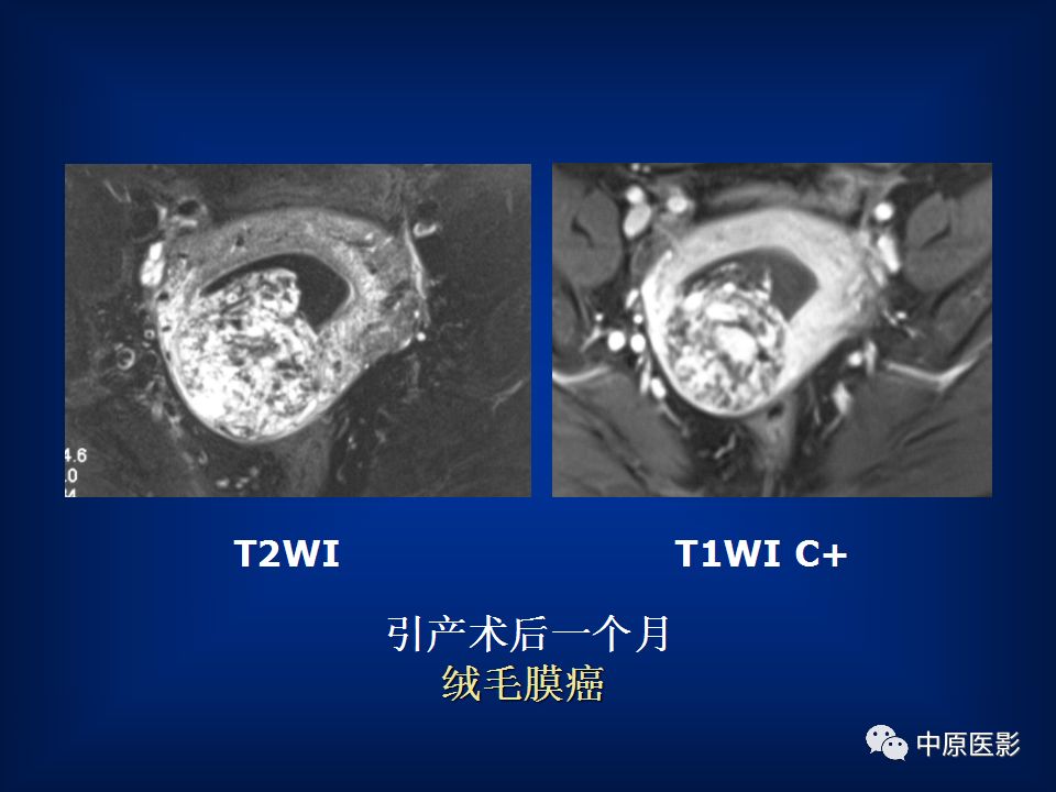 影像PPT - 【PPT】胎盘植入的MRI诊断-35