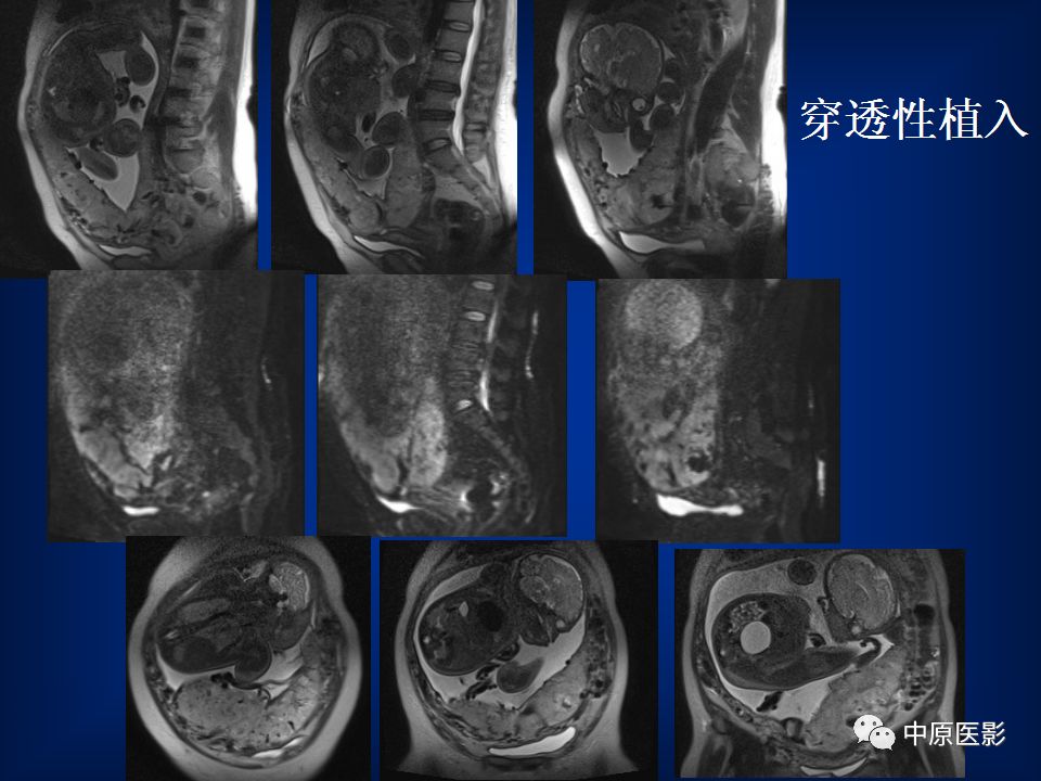 影像PPT - 【PPT】胎盘植入的MRI诊断-1