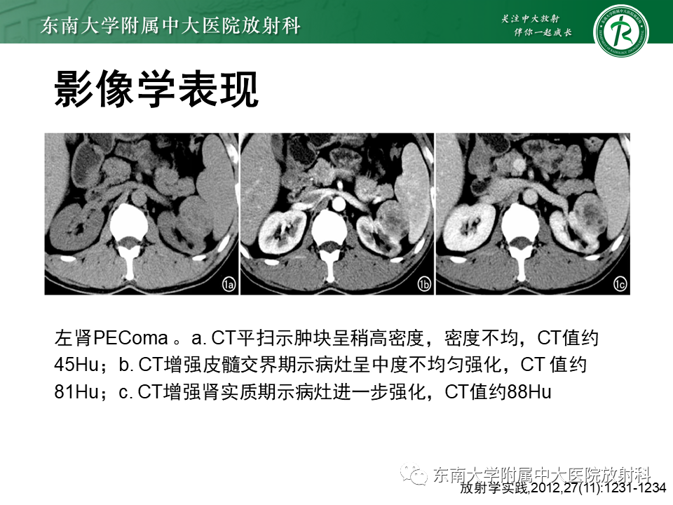 影像PPT - 【PPT】肾脏上皮样血管平滑肌脂肪瘤-10
