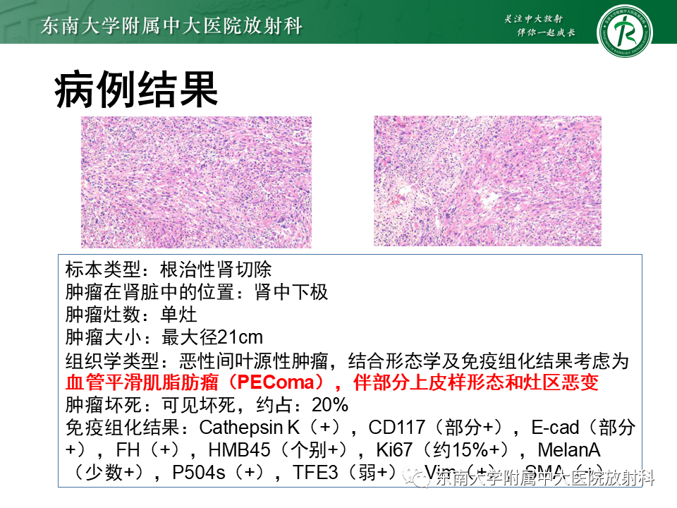 影像PPT - 【PPT】肾脏上皮样血管平滑肌脂肪瘤-4