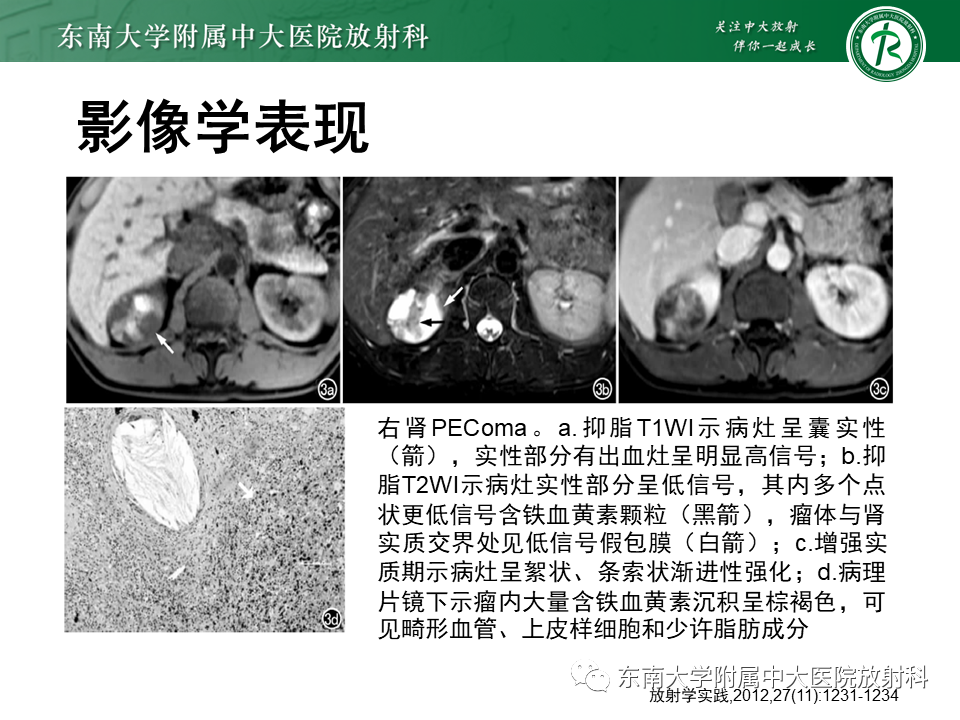 影像PPT - 【PPT】肾脏上皮样血管平滑肌脂肪瘤-12