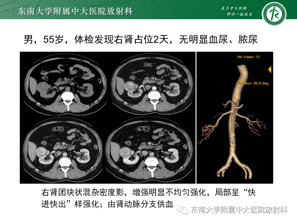 影像PPT - 【PPT】肾脏上皮样血管平滑肌脂肪瘤-14