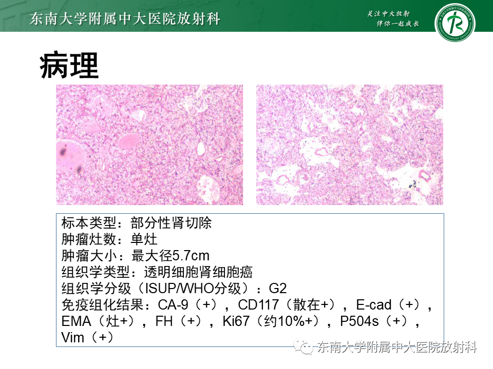 影像PPT - 【PPT】肾脏上皮样血管平滑肌脂肪瘤-15