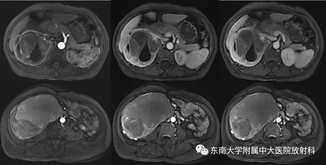 影像PPT - 【PPT】肾脏上皮样血管平滑肌脂肪瘤-3