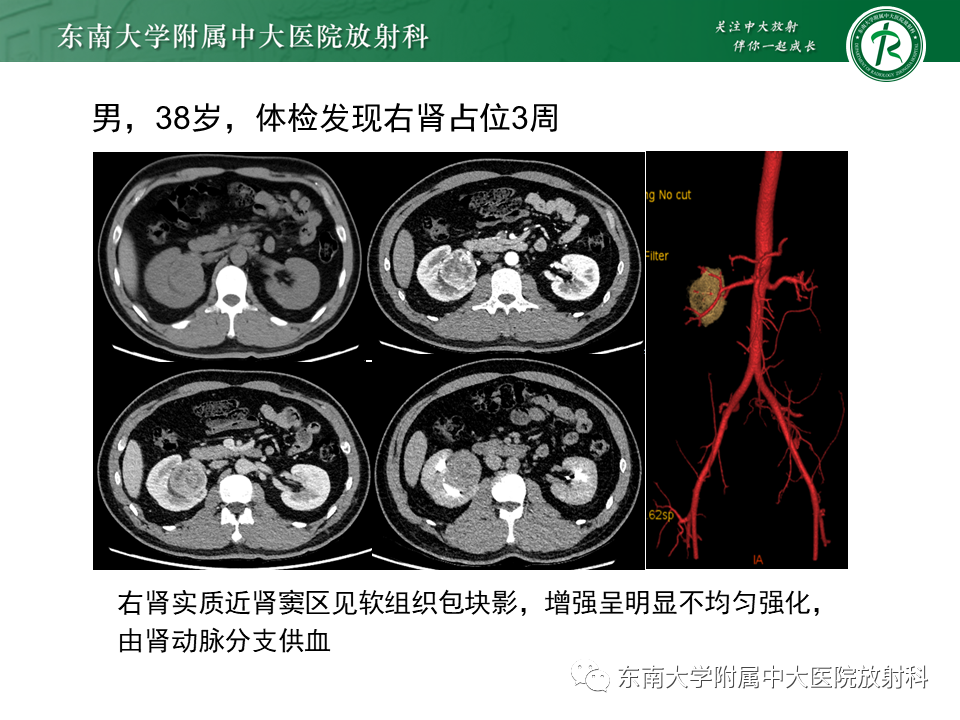 影像PPT - 【PPT】肾脏上皮样血管平滑肌脂肪瘤-18