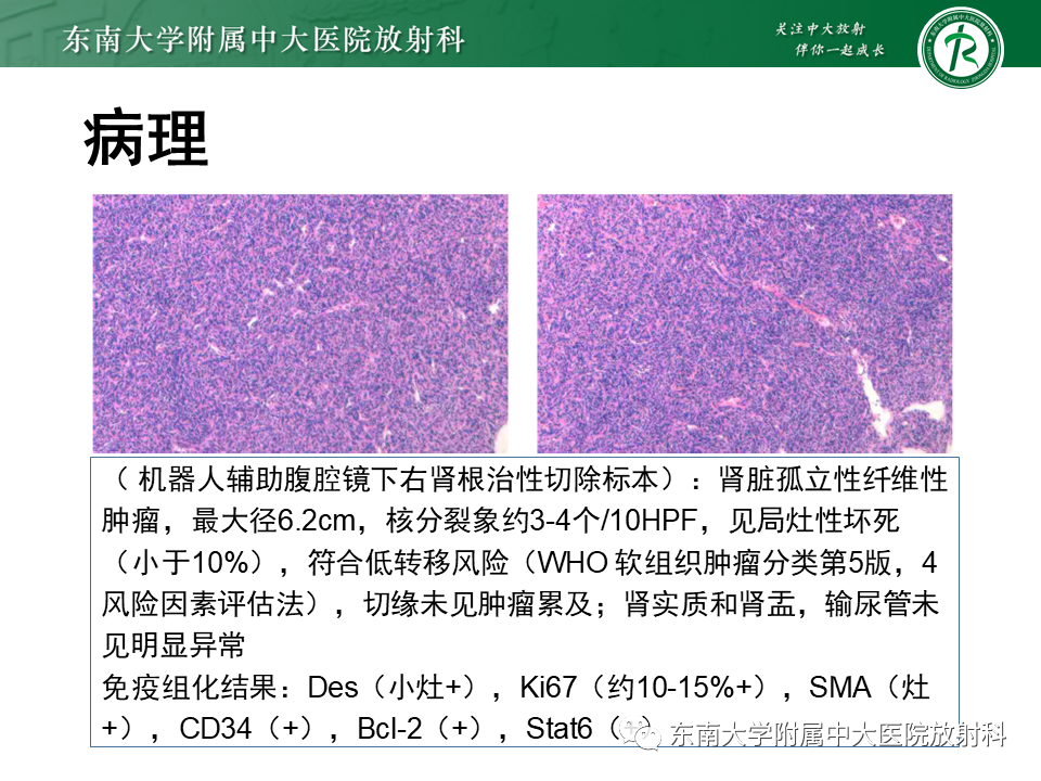 影像PPT - 【PPT】肾脏上皮样血管平滑肌脂肪瘤-19