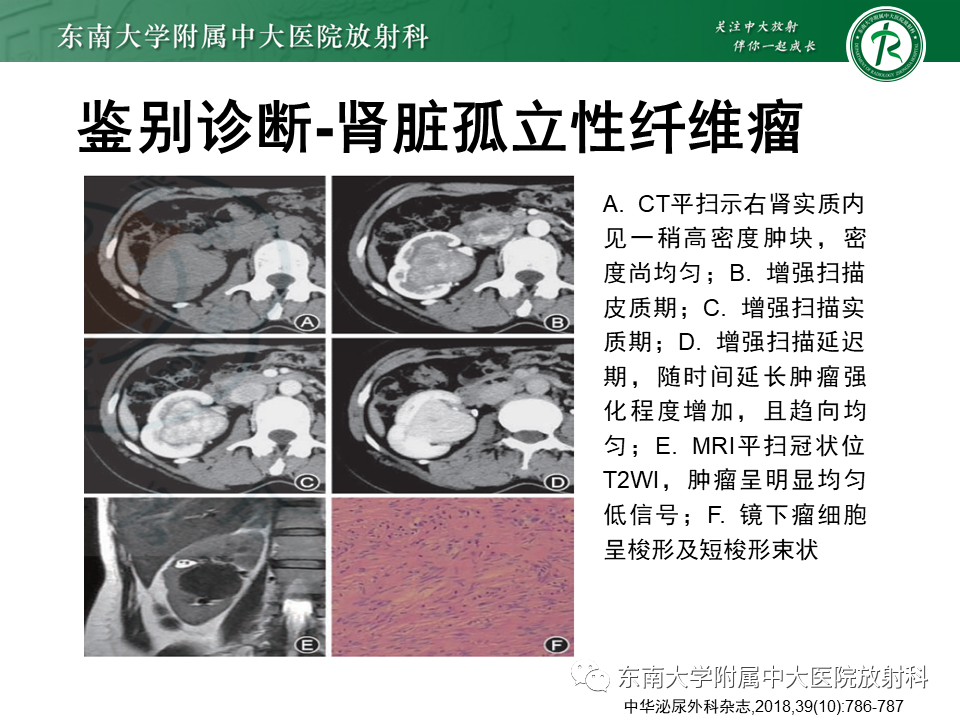 影像PPT - 【PPT】肾脏上皮样血管平滑肌脂肪瘤-22